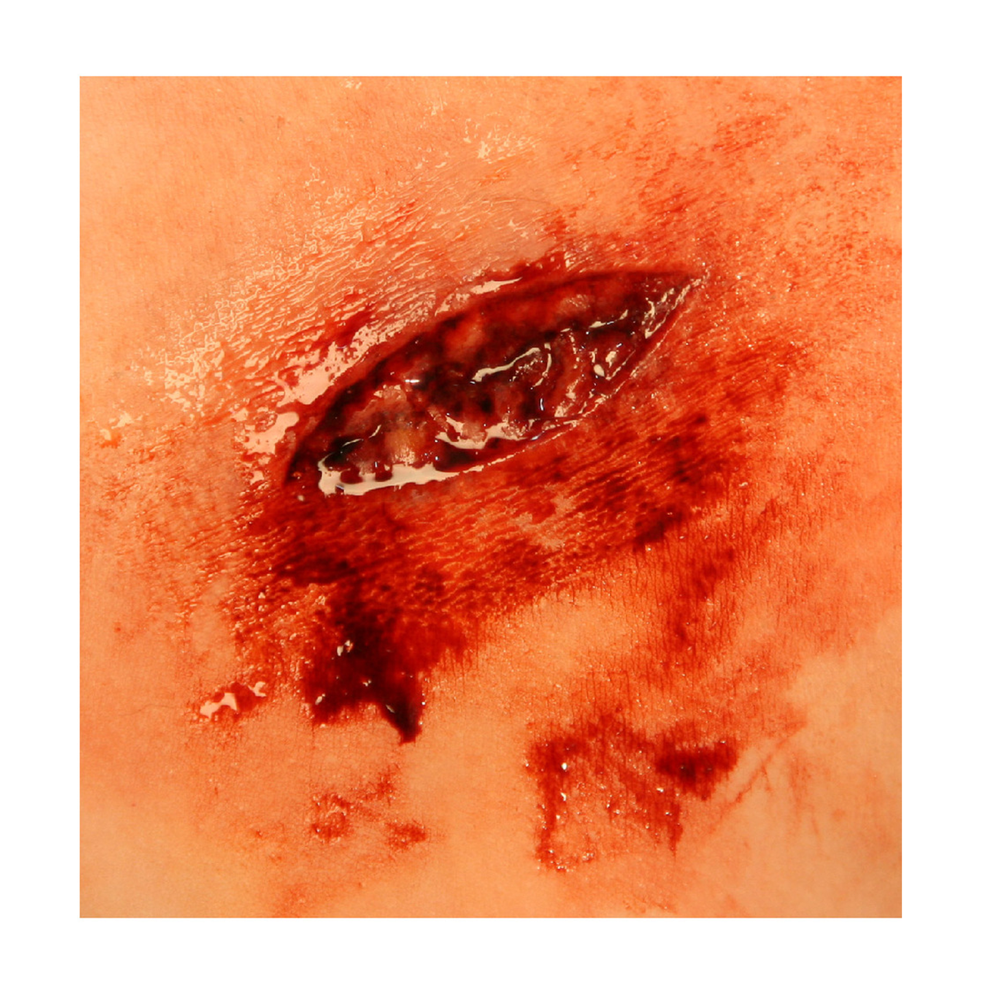 3" Laceration Mold