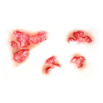 Tinsley Burned Flesh Transfer