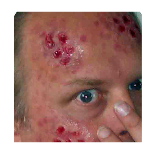 Water-Melon Lesions Aired Kit